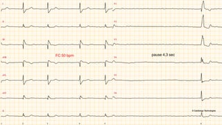 FC 50 bpm pause 4,3 sec
 