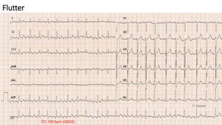 Flutter
FC 150 bpm (300/2)
 