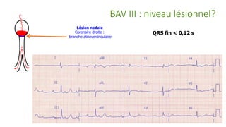 BAV III : niveau lésionnel?
Lésion nodale
Coronaire droite :
branche atrioventriculaire
QRS fin < 0,12 s
 