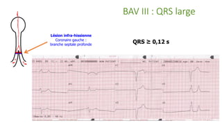 BAV III : QRS large
Lésion infra-hissienne
Coronaire gauche :
branche septale profonde
QRS ≥ 0,12 s
 