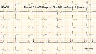 Bloc AV 2:1 à QRS larges et PR < 200 ms (Mobitz 2 (Hay) >> 1)BAV II
 
