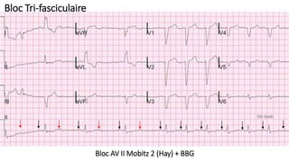 Bloc AV II Mobitz 2 (Hay) + BBG
Bloc Tri-fasciculaire
 