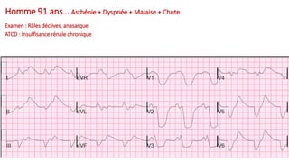 Homme 91 ans… Asthénie + Dyspnée + Malaise + Chute
A.1-1
Examen : Râles déclives, anasarque
ATCD : Insuffisance rénale chronique
 