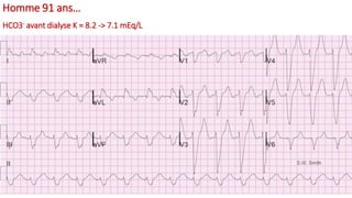 Homme 91 ans…
HCO3- avant dialyse K = 8.2 -> 7.1 mEq/L
A.1-1
 