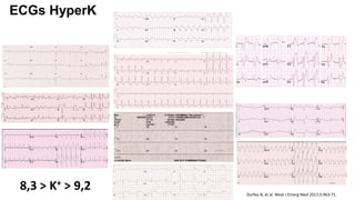 ECGs HyperK
8,3 > K+ > 9,2 Durfey N, et al. West J Emerg Med 2017;5:963-71.
 