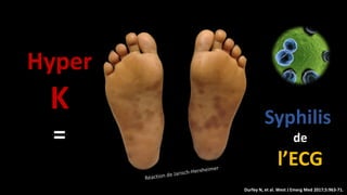Syphilis
de
l’ECG
Hyper
K
=
Durfey N, et al. West J Emerg Med 2017;5:963-71.
 