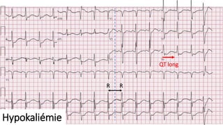 Hypokaliémie
QT long
R R
 