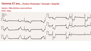 Homme 47 ans… Douleur thoracique + Syncope + Dyspnée
Examen : Râles déclives, sueurs profuses
ATCD : Tabac
 