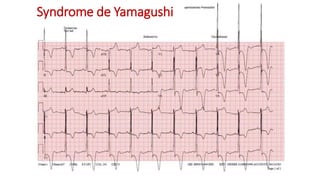 Syndrome de Yamagushi
 