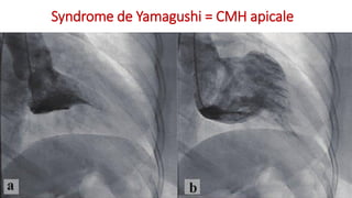 Syndrome de Yamagushi = CMH apicale
 