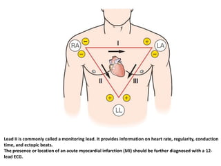Lead II is commonly called a monitoring lead. It provides information on heart rate, regularity, conduction
time, and ectopic beats.
The presence or location of an acute myocardial infarction (MI) should be further diagnosed with a 12-
lead ECG.
 