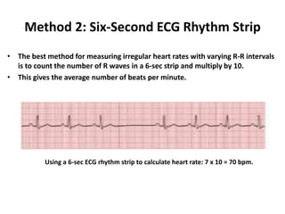 Method 2: Six-Second ECG Rhythm Strip
• The best method for measuring irregular heart rates with varying R-R intervals
is to count the number of R waves in a 6-sec strip and multiply by 10.
• This gives the average number of beats per minute.
Using a 6-sec ECG rhythm strip to calculate heart rate: 7 x 10 = 70 bpm.
 