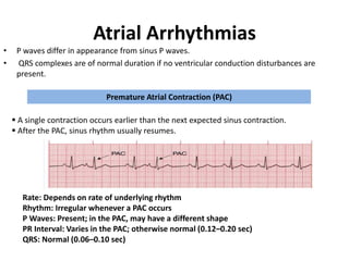 Atrial Arrhythmias
• P waves differ in appearance from sinus P waves.
• QRS complexes are of normal duration if no ventricular conduction disturbances are
present.
Premature Atrial Contraction (PAC)
 A single contraction occurs earlier than the next expected sinus contraction.
 After the PAC, sinus rhythm usually resumes.
PAC PAC
Rate: Depends on rate of underlying rhythm
Rhythm: Irregular whenever a PAC occurs
P Waves: Present; in the PAC, may have a different shape
PR Interval: Varies in the PAC; otherwise normal (0.12–0.20 sec)
QRS: Normal (0.06–0.10 sec)
 