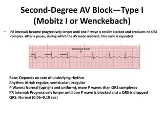 Second-Degree AV Block—Type I
(Mobitz I or Wenckebach)
• PR intervals become progressively longer until one P wave is totally blocked and produces no QRS
complex. After a pause, during which the AV node recovers, this cycle is repeated.
Rate: Depends on rate of underlying rhythm
Rhythm: Atrial: regular; ventricular: irregular
P Waves: Normal (upright and uniform), more P waves than QRS complexes
PR Interval: Progressively longer until one P wave is blocked and a QRS is dropped
QRS: Normal (0.06–0.10 sec)
 