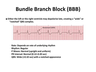 Bundle Branch Block (BBB)
■ Either the left or the right ventricle may depolarize late, creating a “wide” or
“notched” QRS complex.
Rate: Depends on rate of underlying rhythm
Rhythm: Regular
P Waves: Normal (upright and uniform)
PR Interval: Normal (0.12–0.20 sec)
QRS: Wide (>0.10 sec) with a notched appearance
 