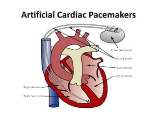 Artificial Cardiac Pacemakers
 