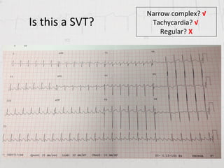Svt Complex Geraldine Leong - ECG for paramedics | PPT
