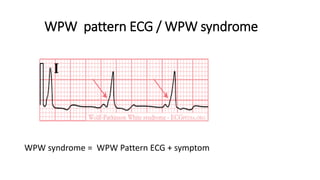 WPW pattern ECG / WPW syndrome
WPW syndrome = WPW Pattern ECG + symptom
 