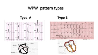WPW pattern types
Type A Type B
 