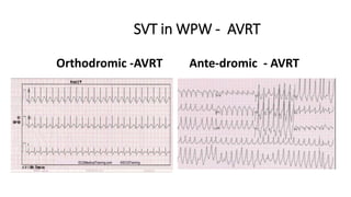 SVT in WPW - AVRT
Orthodromic -AVRT Ante-dromic - AVRT
 
