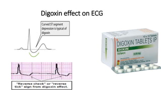 Digoxin effect on ECG
 
