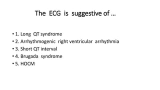 The ECG is suggestive of …
• 1. Long QT syndrome
• 2. Arrhythmogenic right ventricular arrhythmia
• 3. Short QT interval
• 4. Brugada syndrome
• 5. HOCM
 