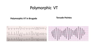 Polymorphic VT
Polymorphic VT in Brugada Torsade Pointes
 