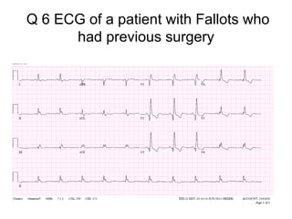 Q 6 ECG of a patient with Fallots who
had previous surgery

 