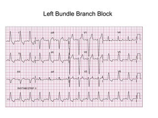 Left Bundle Branch Block

 