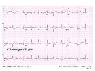 Q 7 what type of Rhythm

 