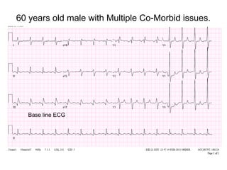 60 years old male with Multiple Co-Morbid issues.

Base line ECG

 