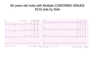 60 years old male with Multiple COMORBID ISSUES
ECG side by Side

 