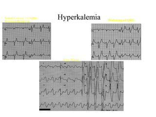 Peaked T waves ( > 1/3 QRS)
Prolonged PR interval

Hyperkalemia

Sine Wave

Widening of QRS

 