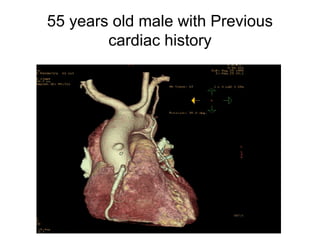 55 years old male with Previous
cardiac history

 