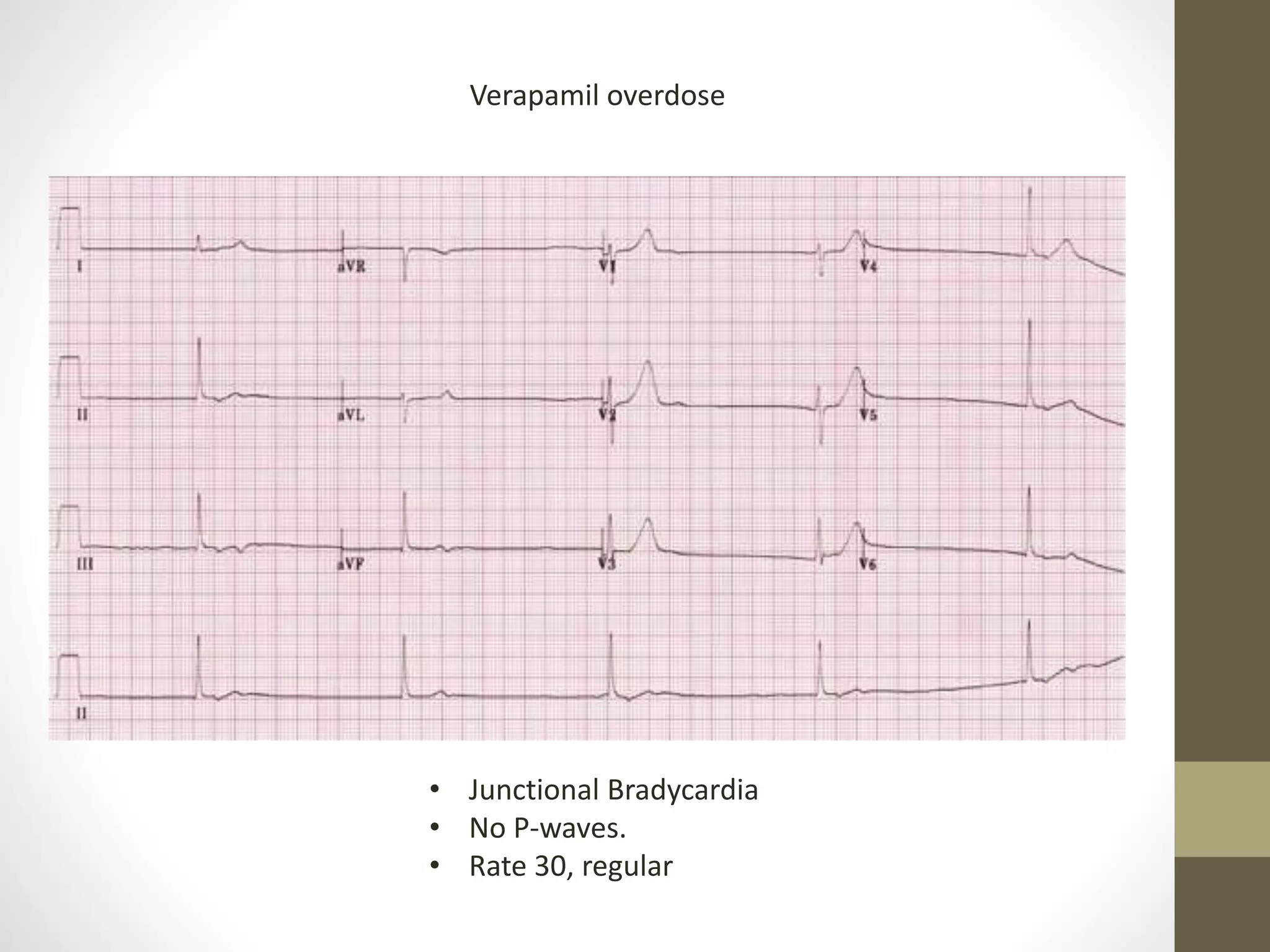 • Junctional Bradycardia
• No P-waves.
• Rate 30, regular
Verapamil overdose
 