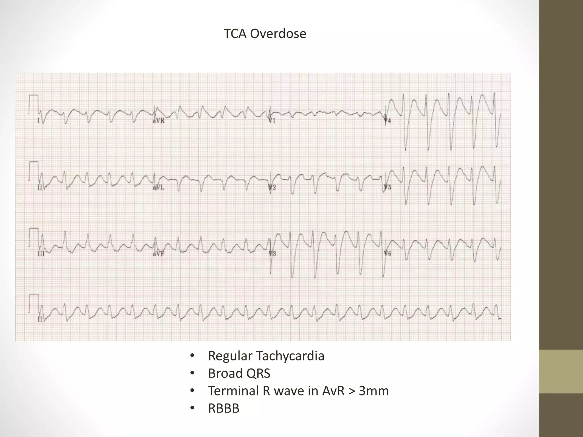 • Regular Tachycardia
• Broad QRS
• Terminal R wave in AvR > 3mm
• RBBB
TCA Overdose
 