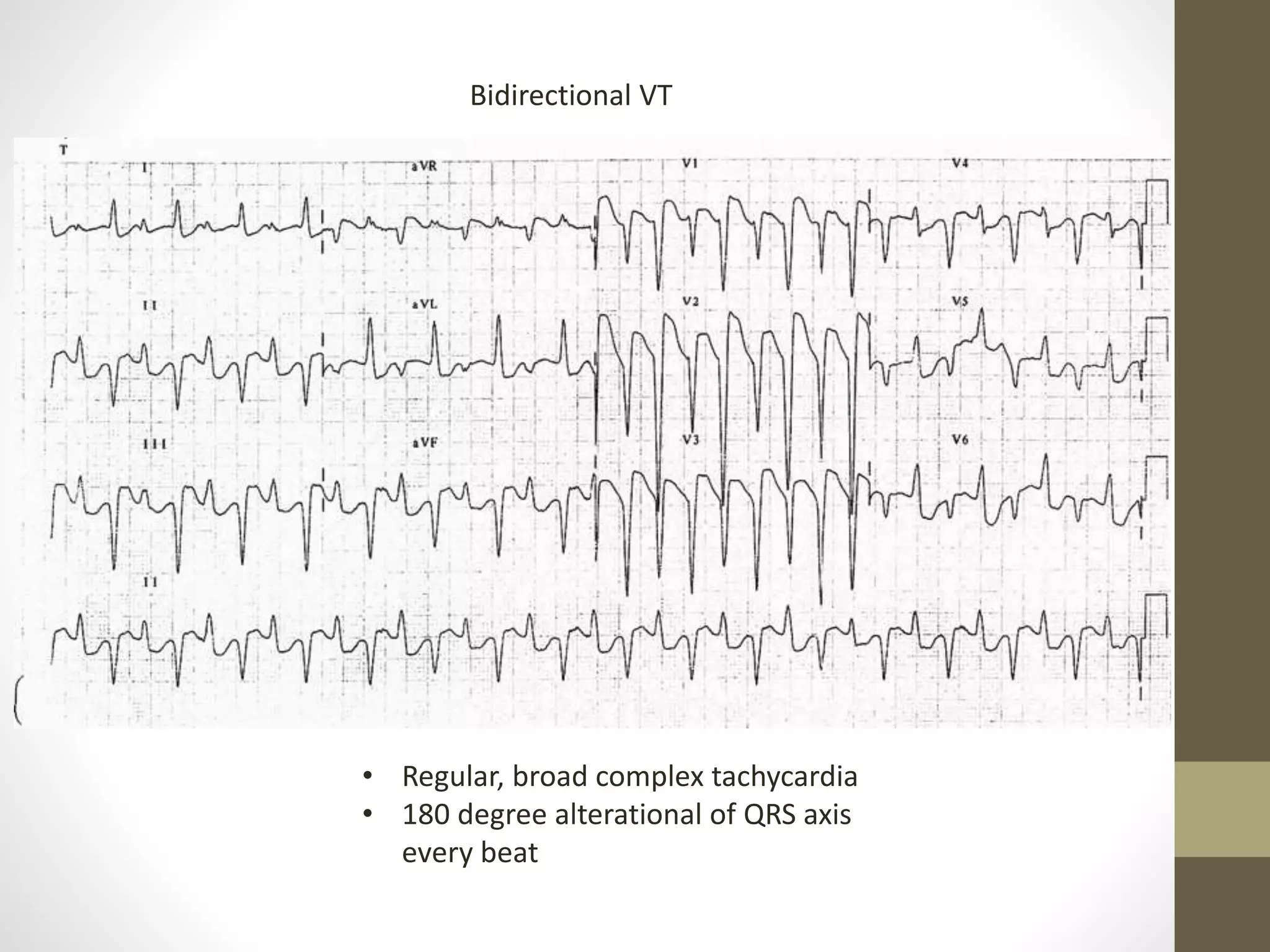 Bidirectional VT
• Regular, broad complex tachycardia
• 180 degree alterational of QRS axis
every beat
 