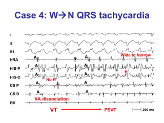Case 4: W  N QRS tachycardia VA dissociation VT H PSVT No H Wide to Narrow 