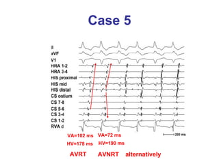 Case 5 VA=102 ms VA=72 ms HV=178 ms HV=190 ms AVRT AVNRT alternatively 