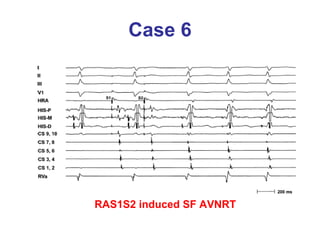 Case 6 RAS1S2 induced SF AVNRT 