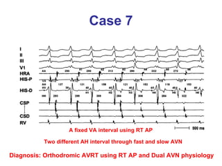 Case 7 Diagnosis: Orthodromic AVRT using RT AP and Dual AVN physiology A fixed VA interval using RT AP Two different AH interval through fast and slow AVN 