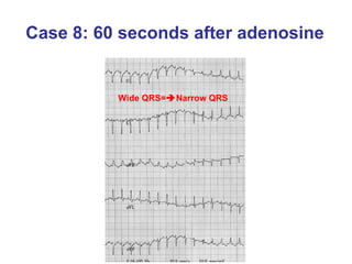 Case 8: 60 seconds after adenosine Wide QRS=  Narrow QRS 