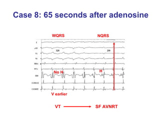 Case 8: 65 seconds after adenosine H WQRS NQRS SF AVNRT No H V earlier VT 