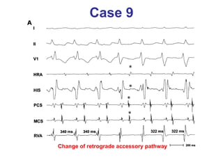 Case 9 Change of retrograde accessory pathway 