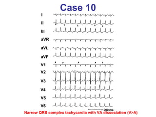 Case 10 Narrow QRS complex tachycardia with VA dissociation (V>A) 