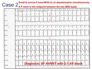 Case 2 Small & narrow P wave  RA & LA depolarization simultaneously  Diagnosis: SF AVNRT with 2:1 AV block A P wave in the midpoint between the two QRS beats  