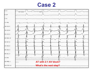 Case 2 AT with 2:1 AV block? What’s the next step? 