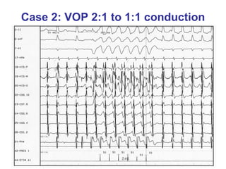 Case 2: VOP 2:1 to 1:1 conduction 
