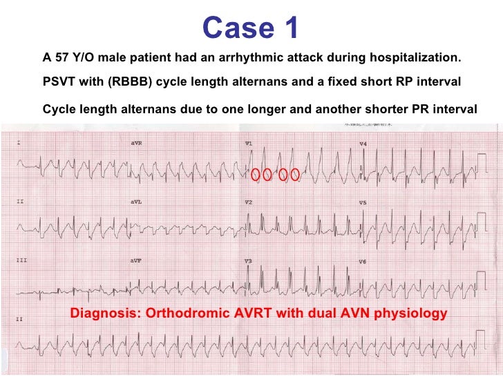 Ecg Tracings Teaching