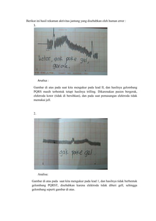 Berikut ini hasil rekaman aktivitas jantung yang disebabkan oleh human error :
1.
Analisa :
Gambar di atas pada saat kita mengukur pada lead II, dan hasilnya gelombang
PQRS masih terbentuk tetapi hasilnya trilling. Dikarenakan pasien bergerak,
elektroda kotor (tidak di bersihkan), dan pada saat pemasangan elektroda tidak
memakai jell.
2.
Analisa:
Gambar di atas pada saat kita mengukur pada lead 1, dan hasilnya tidak berbentuk
gelombang PQRST, disebabkan karena elektroda tidak diberi gell, sehingga
gelombang seperti gambar di atas.
 